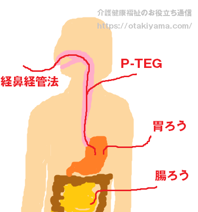 胃ろう（ペグ）・経鼻胃管栄養・中心静脈栄養の違いと注意点